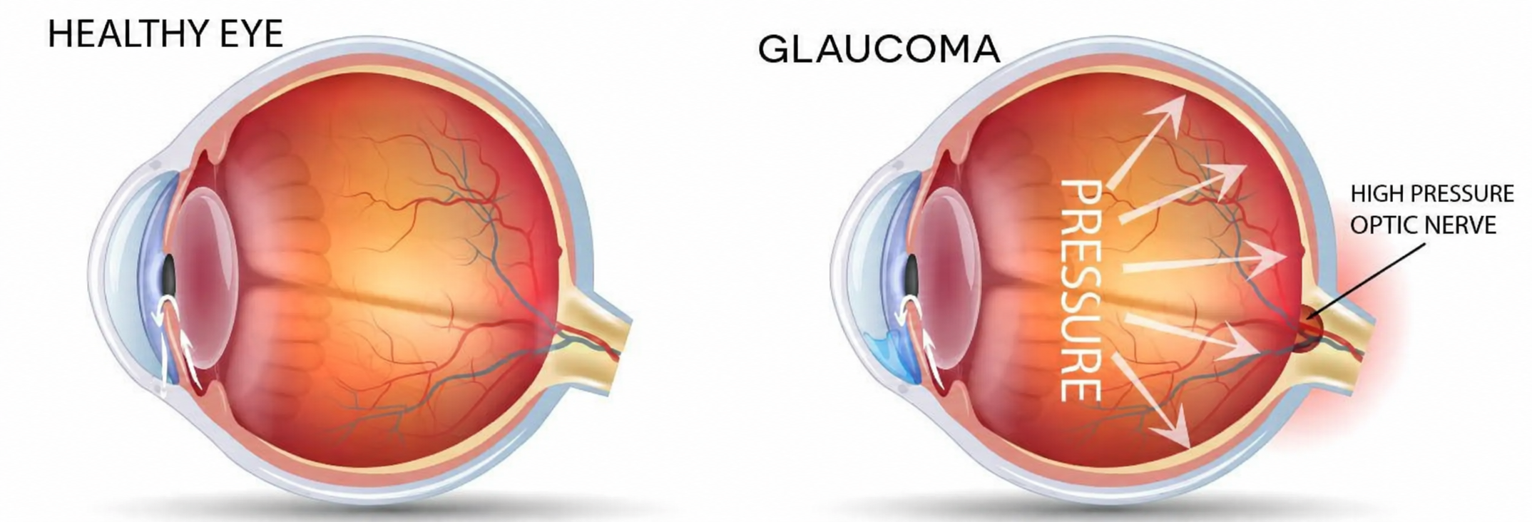 Comparison of a healthy eye and glaucoma, showing high pressure and the optic nerve.